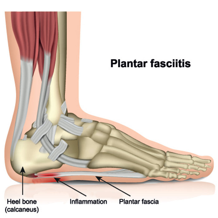 Orthopedic Shoes for Plantar Fasciitis: Finding Relief and Comfort